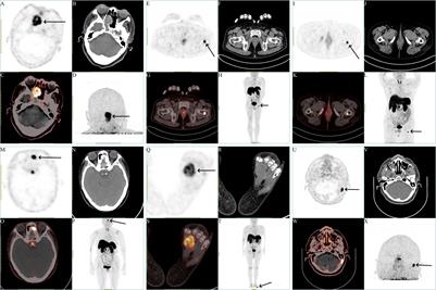 18F-AlF-NOTA-octreotide PET/CT in the localization of tumor-induced osteomalacia: case series and literature review